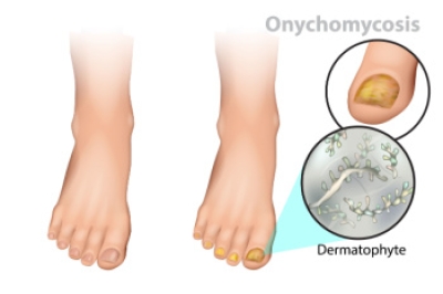 Types of Toenail Fungus